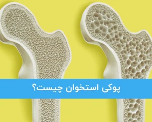 پوکی استخوان چیست؟